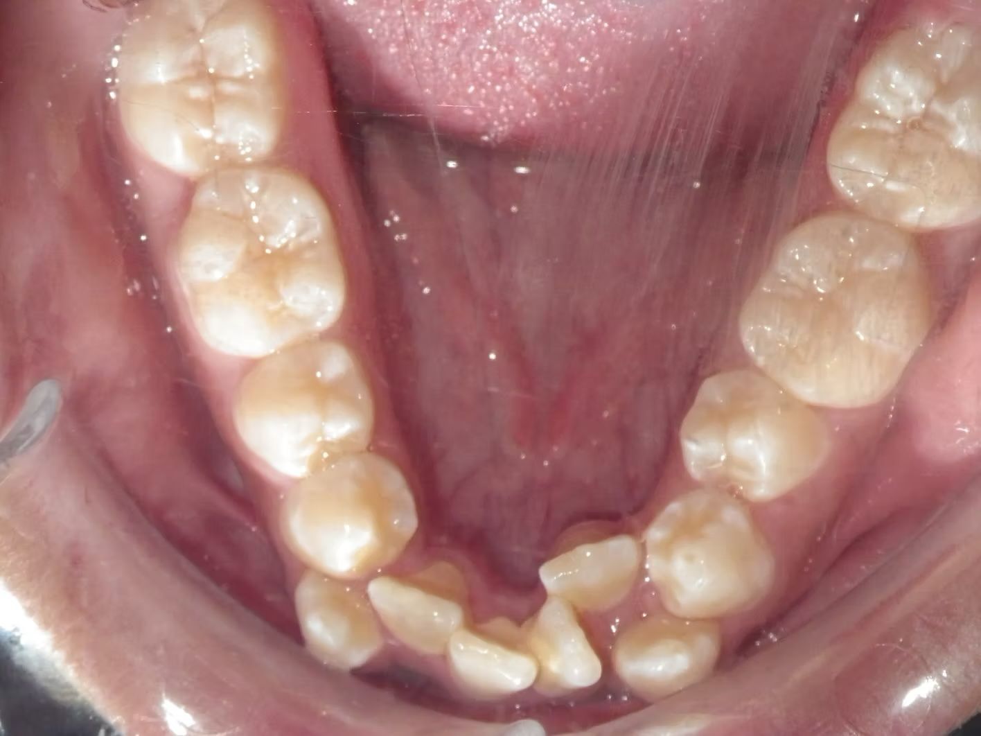 Upper view of a person's teeth, showing molars and incisors. The teeth are yellow and tightly packed.