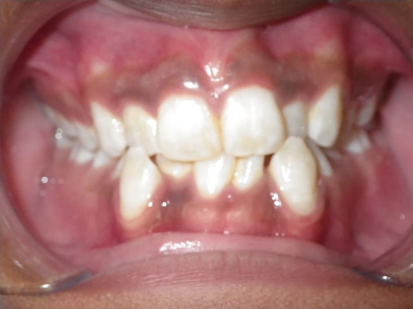 Open mouth showing misaligned, stained teeth and pink gums.