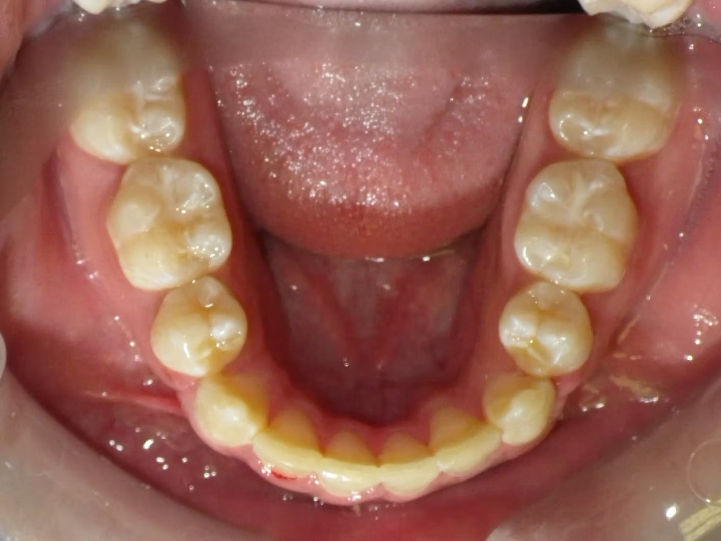 Mouth interior showing upper and lower molars and incisors, pink gums, and a tongue.
