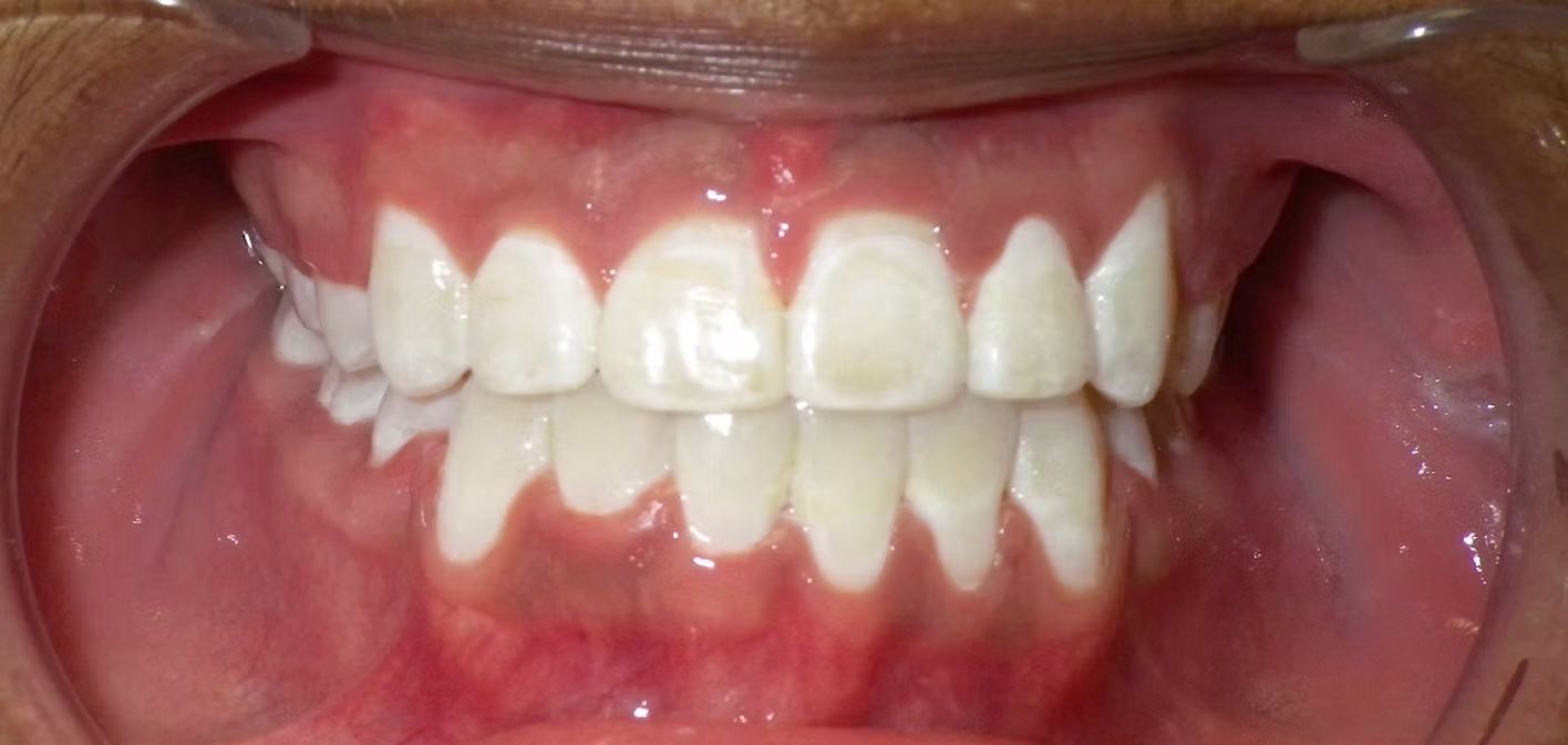 Close-up view of a person's teeth, showing upper and lower rows of white teeth with pink gums.