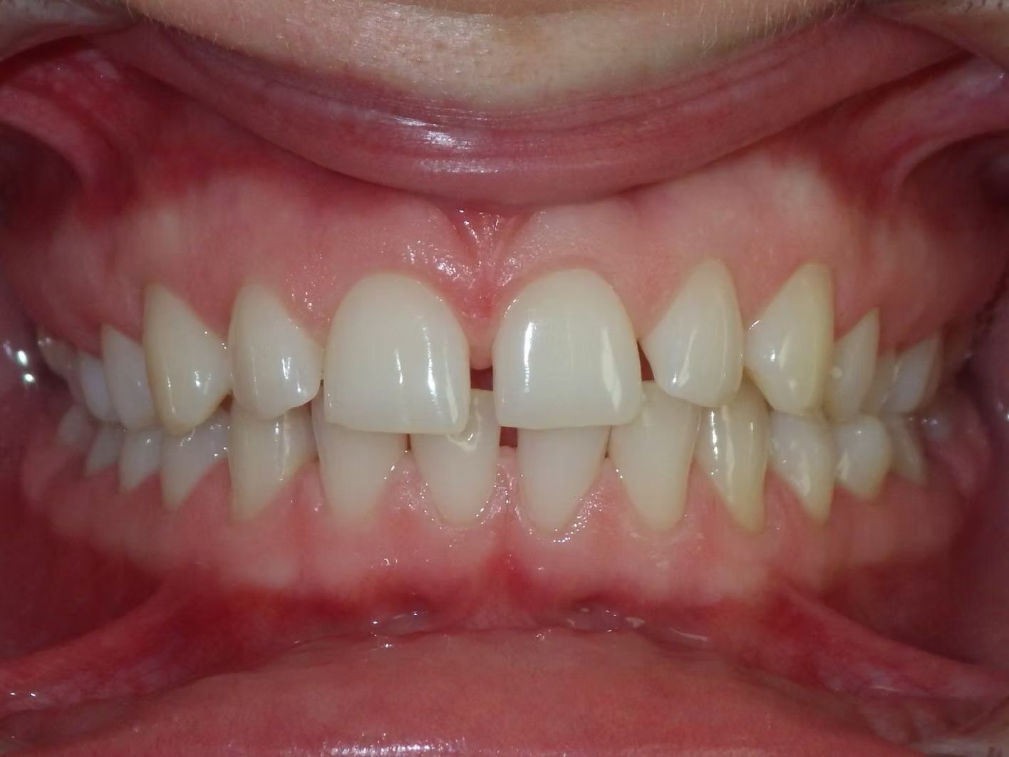 Close-up of a person's teeth showing a noticeable gap between the two front teeth and healthy gums.
