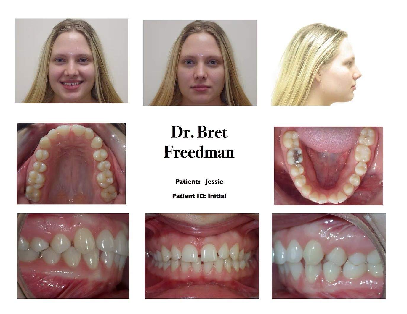 Orthodontic presentation: woman's teeth, before treatment. Front, side, and dental views. Name: Dr. Bret Freedman.