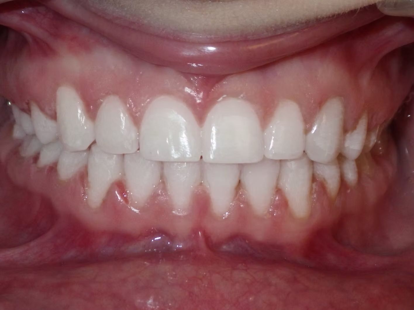 Close-up of human teeth, white and aligned, set against pink gums.