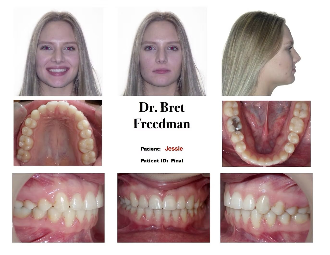 Orthodontic before-and-after of a person's teeth and face. Includes front, side, and mouth views.