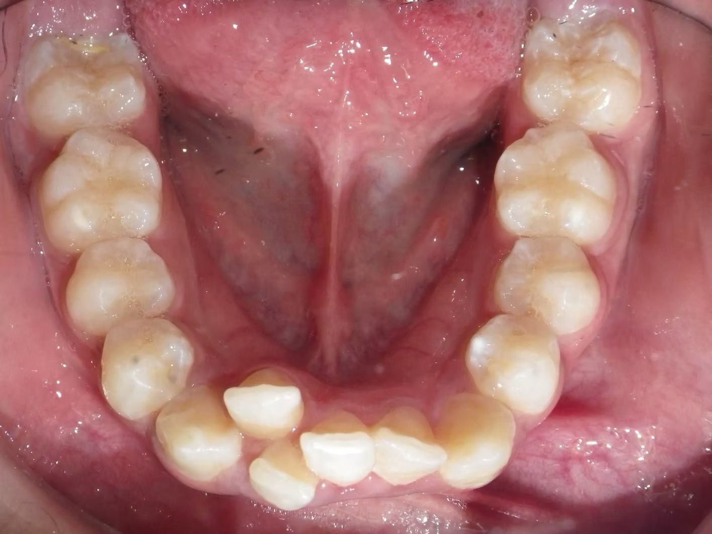 Open mouth, close-up view of the upper and lower teeth, tongue visible, with a light pink palate.