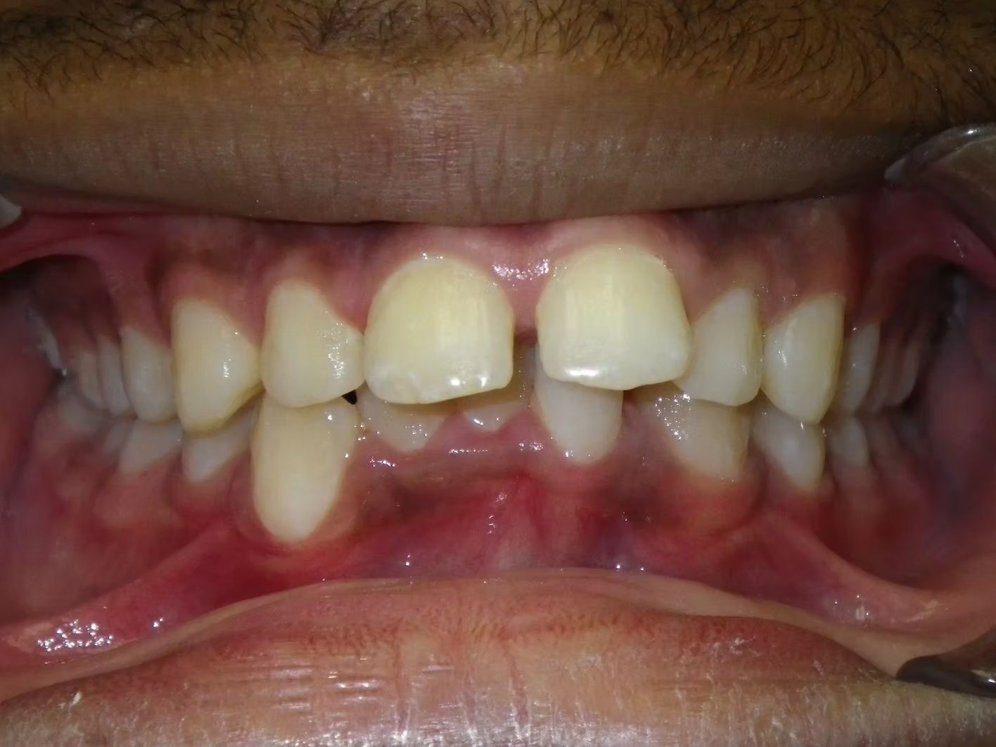 Close-up view of a person's open mouth, revealing teeth with a noticeable gap and crowding.