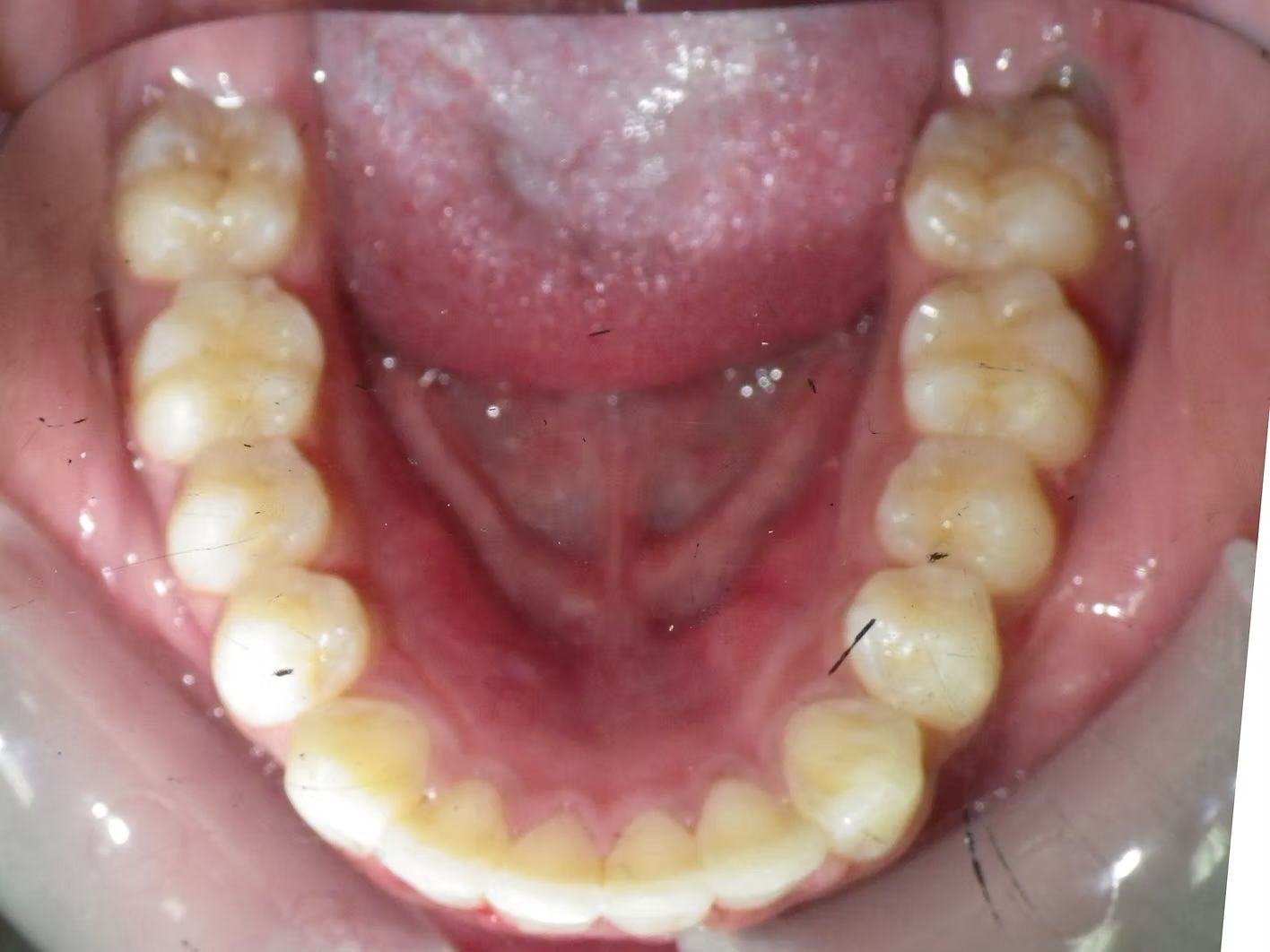 Interior view of a mouth showing the upper and lower teeth, with the tongue visible in the center.