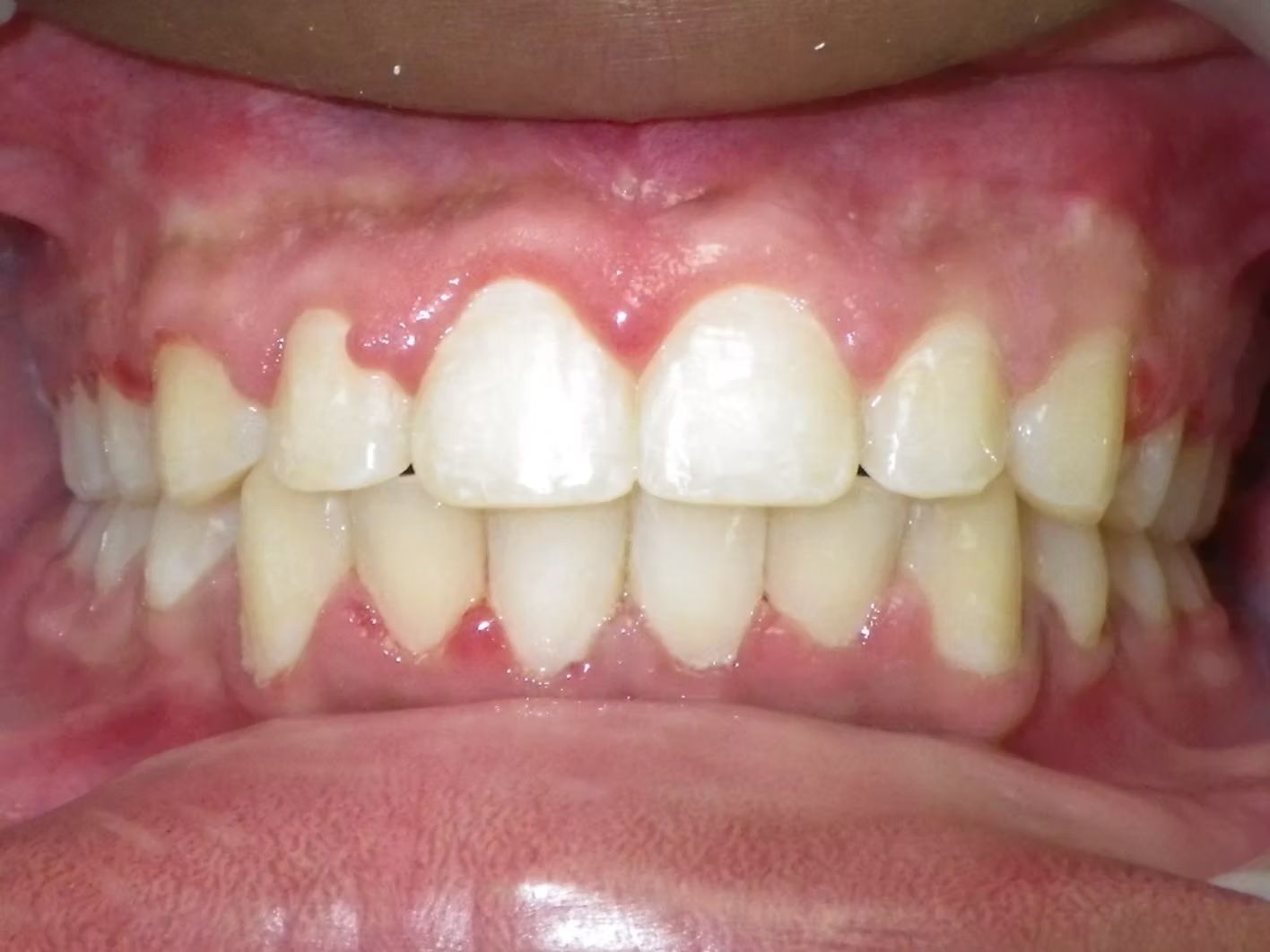 Close-up of a person's mouth showing teeth and gums; inflamed gums with some recession; white teeth.