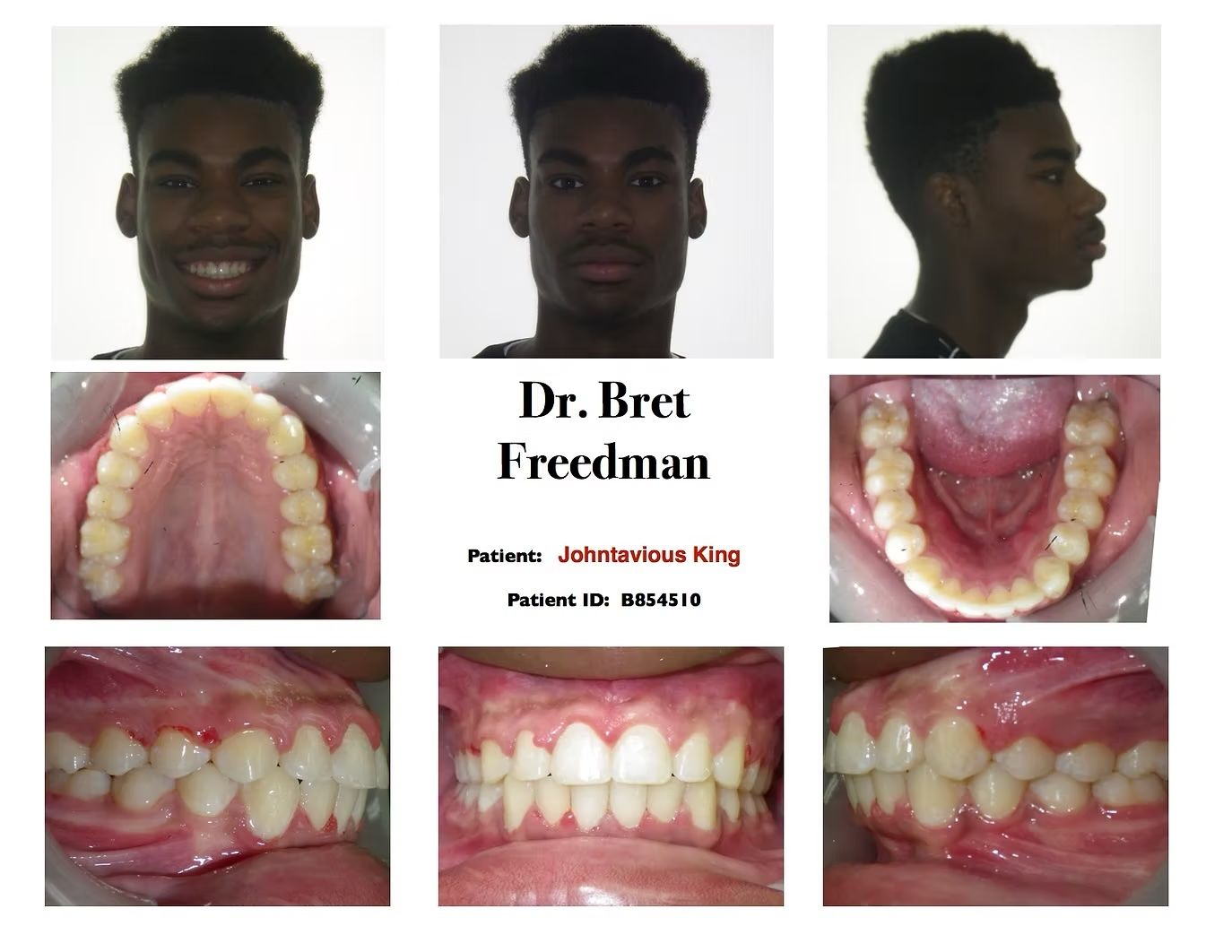 Orthodontic patient's dental and facial images. Includes front, side views and intraoral photos.