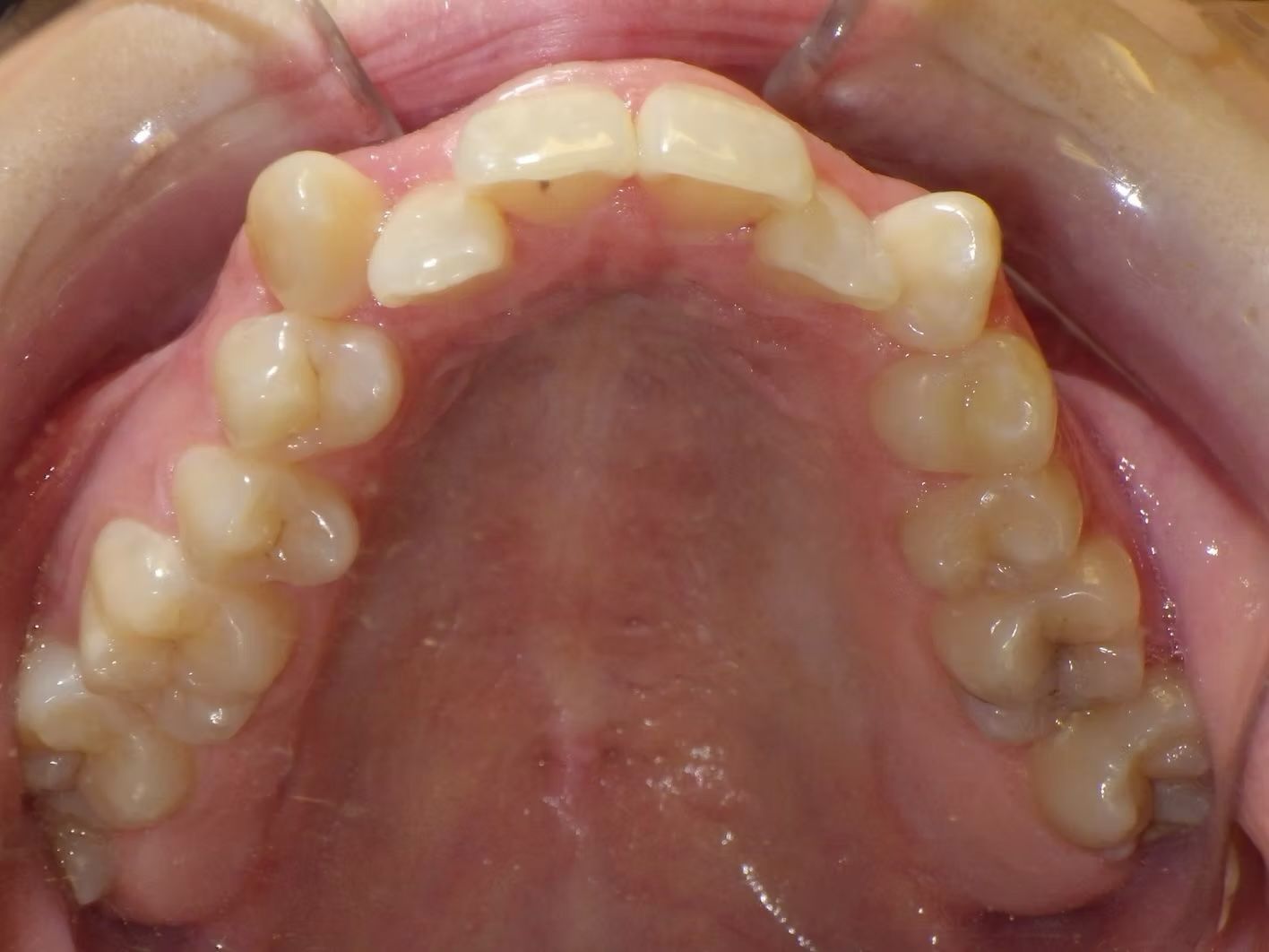 Close-up view of the upper teeth in a person's mouth, showing visible teeth alignment and the roof of the mouth.