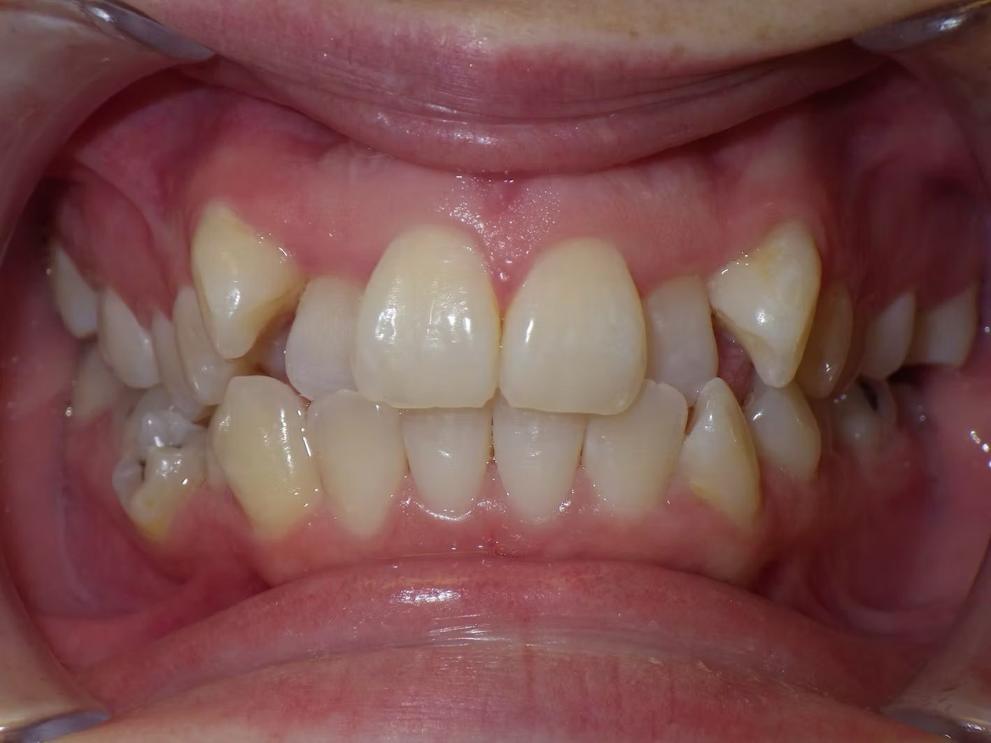 Mouth with misaligned teeth, some yellowed, visible within a pink oral cavity.