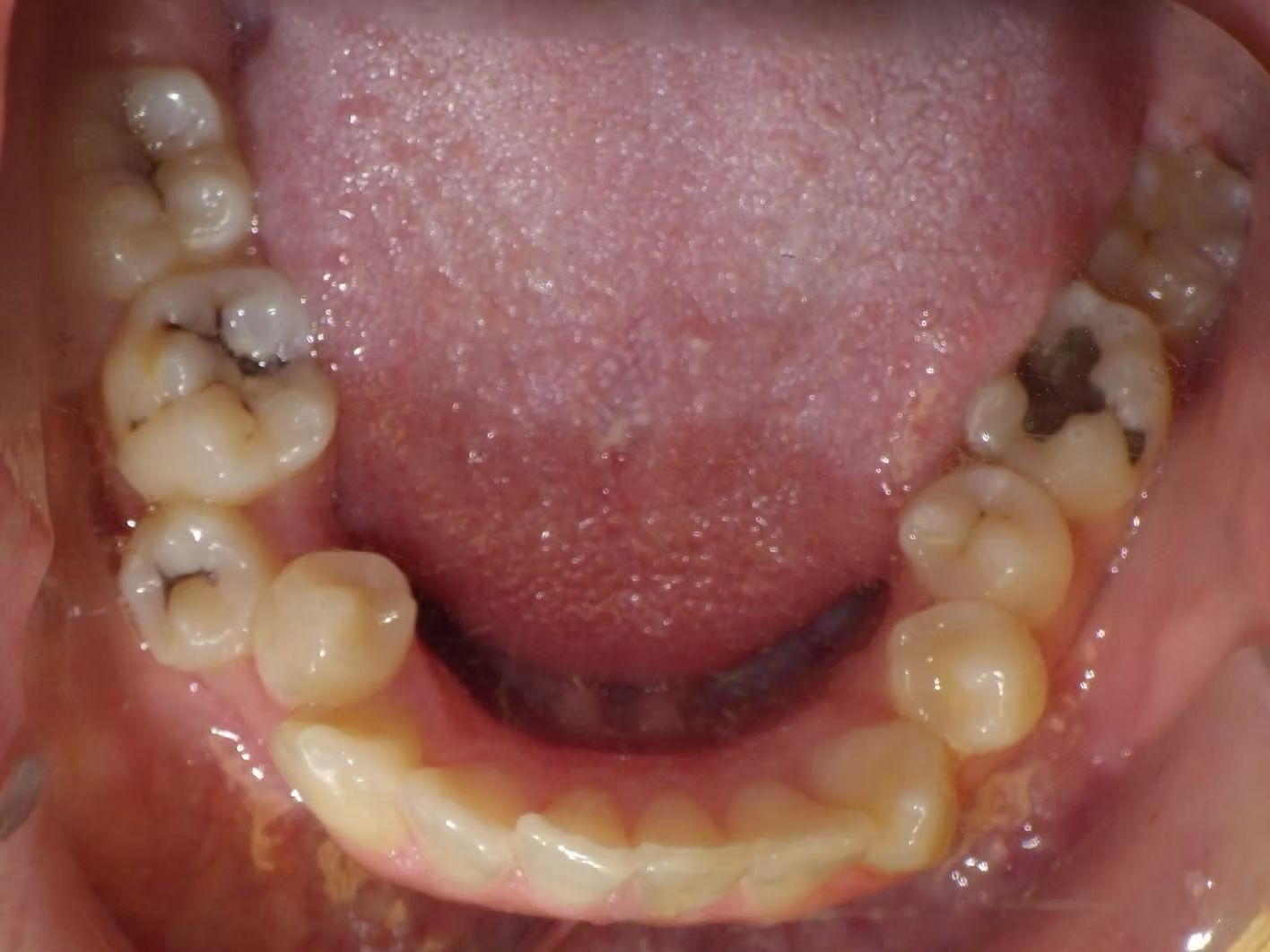 View of the lower teeth and gums, showing several filled teeth and a full lower dental bridge.