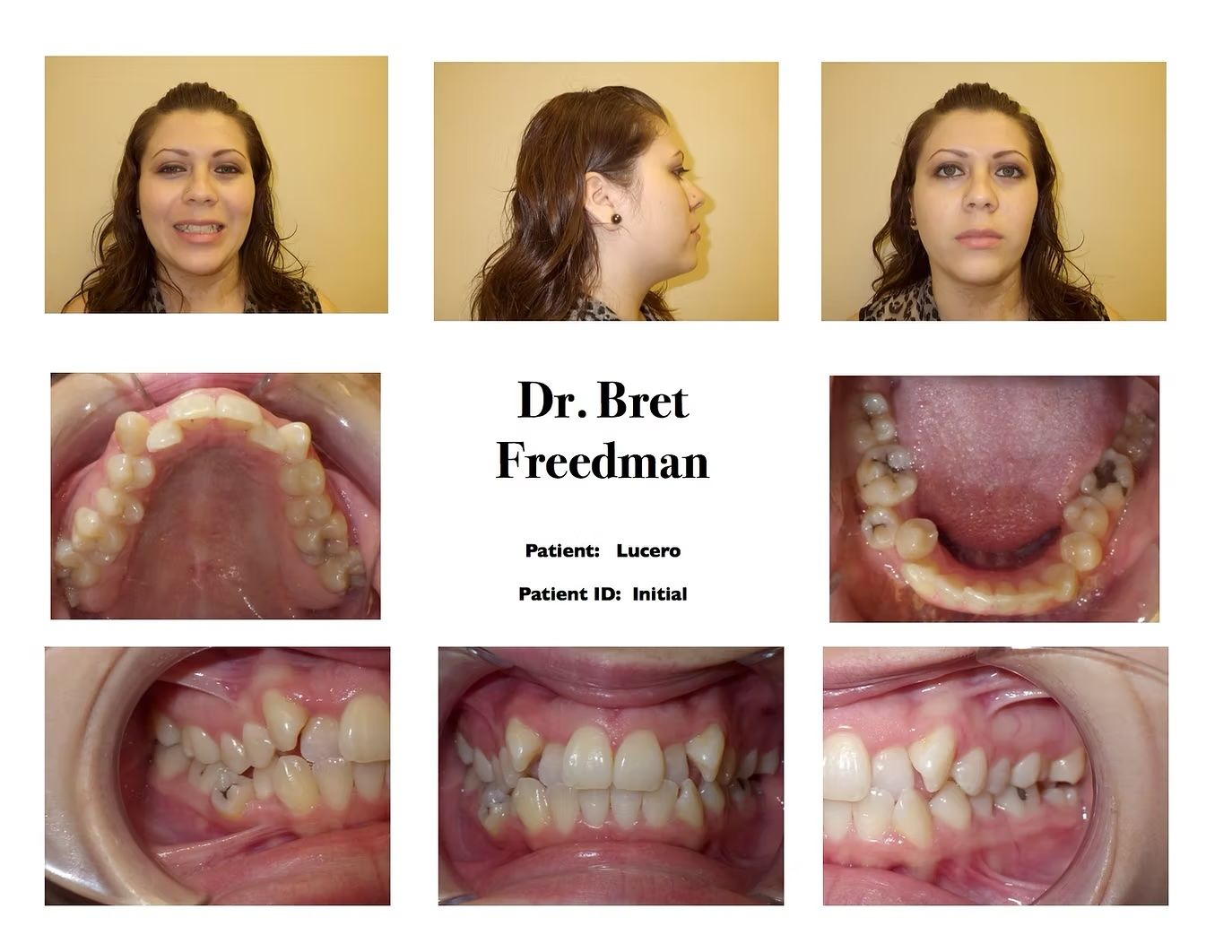 Orthodontic images: woman with dental issues, before treatment. Mouth interior views showing misaligned teeth.