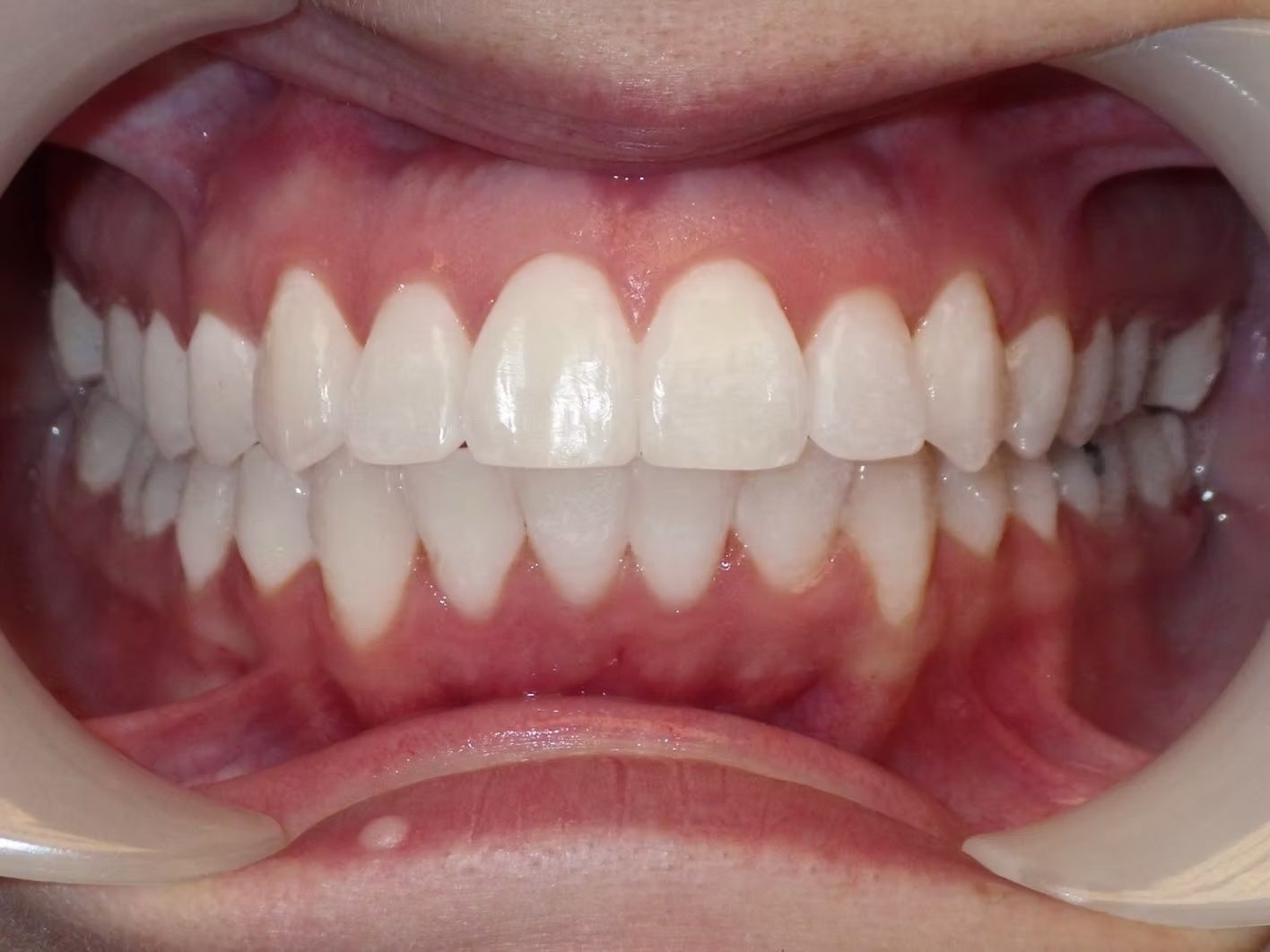 Open view of a person's teeth, white and healthy, with a dental retractor.
