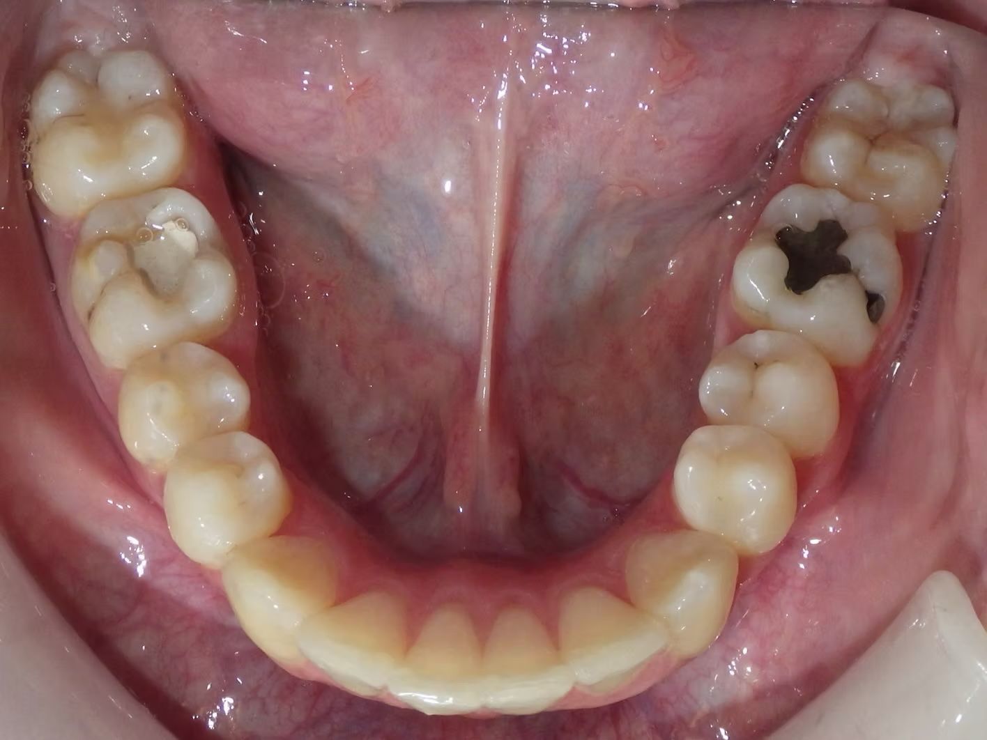 Inside of a mouth with visible teeth. Upper molars show fillings. Lower teeth are visible.