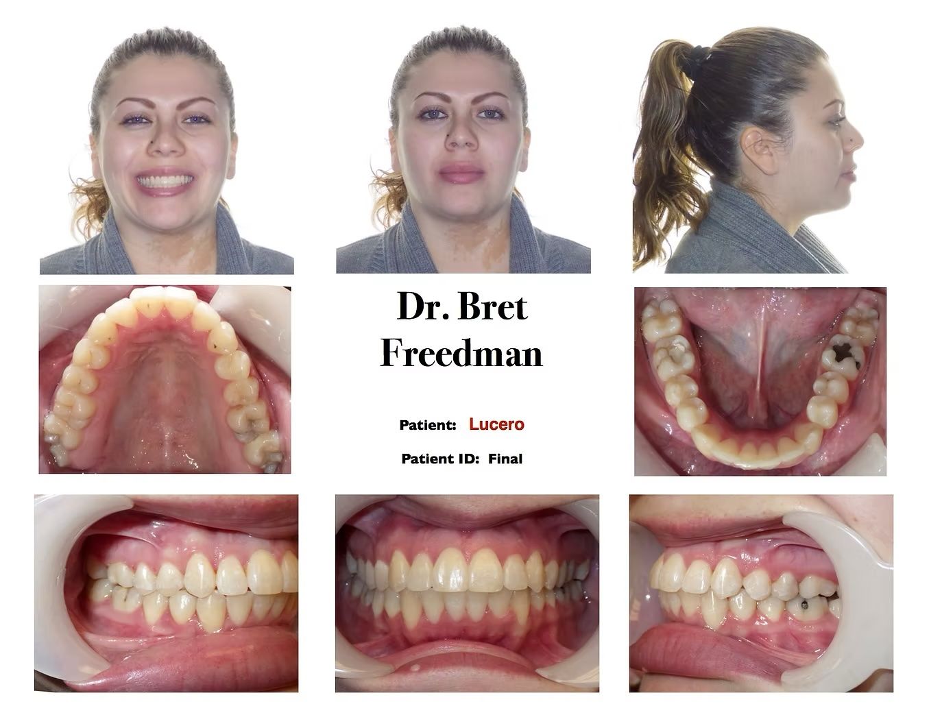 Orthodontic patient photos: Front, face and mouth, and side profile with dental views.