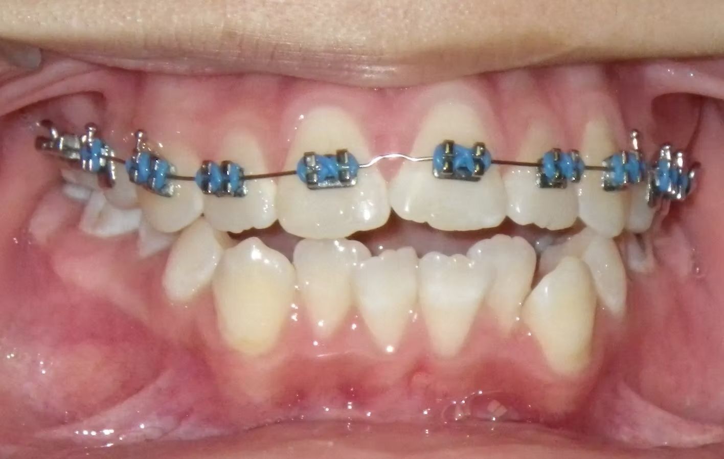 Mouth with braces, top teeth aligned with wire and blue bands. Bottom teeth are not aligned.