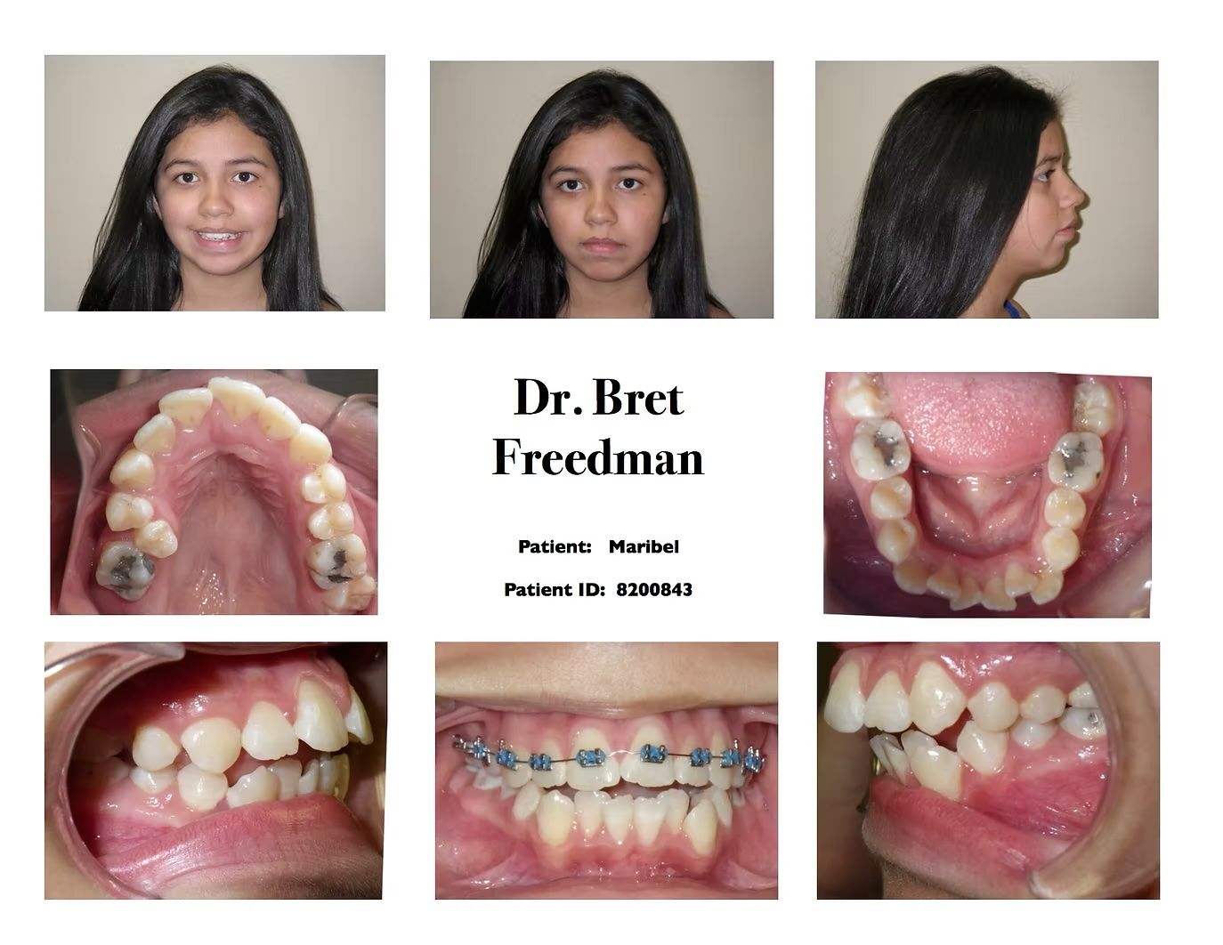 Orthodontic case study: Pre-braces and in-treatment views of a person's teeth, plus facial views.