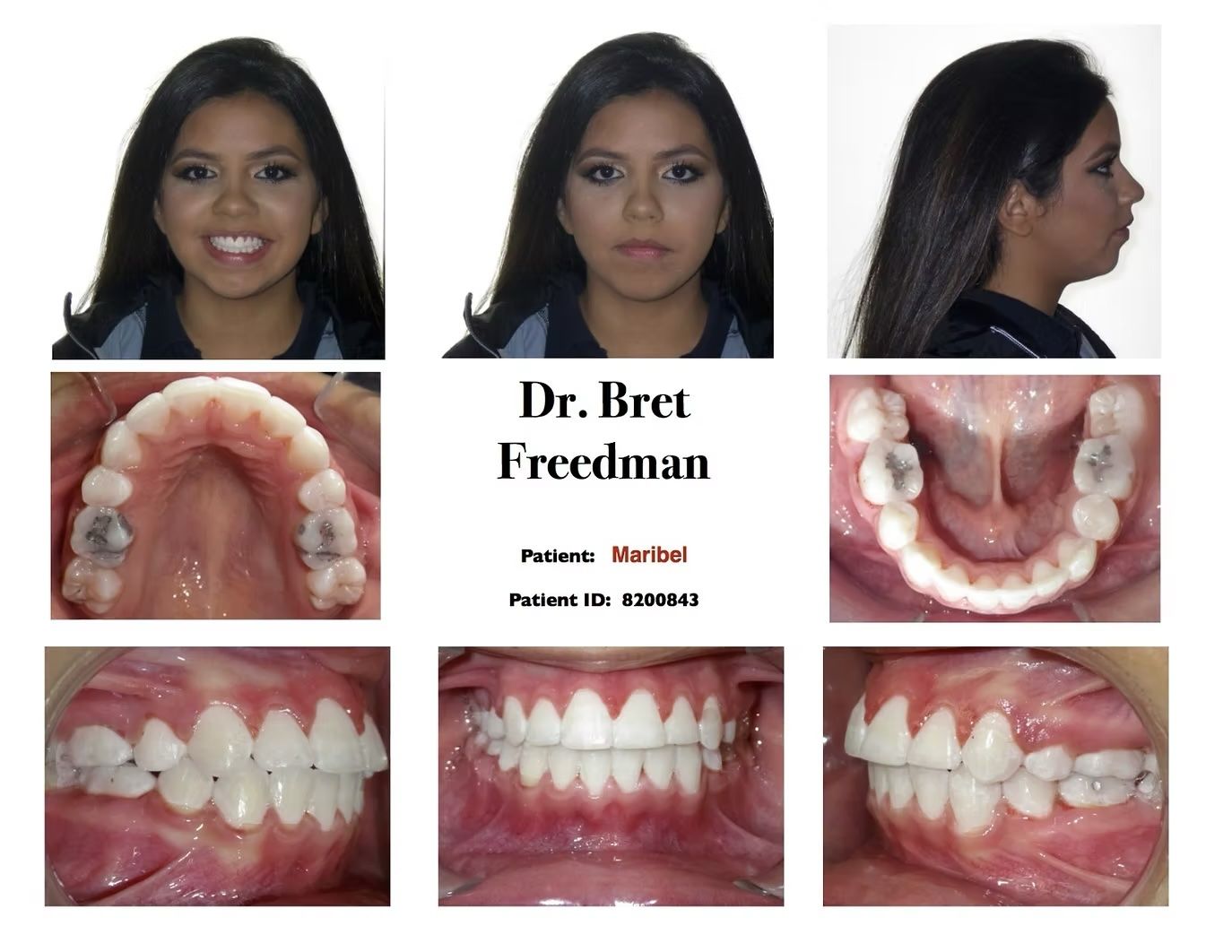 Orthodontic patient's teeth and face. Photos show: smile, front, side views, top/bottom arches, and biting views.