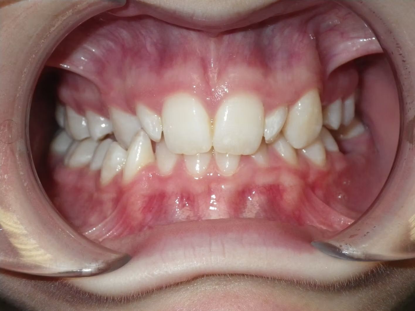 Close-up of a person's mouth with a clear retractor. Teeth show crowding and misalignment.