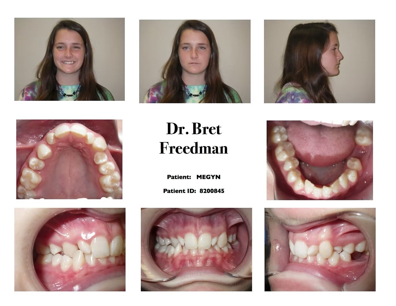 Dental photos show a person's face and teeth before orthodontic treatment.