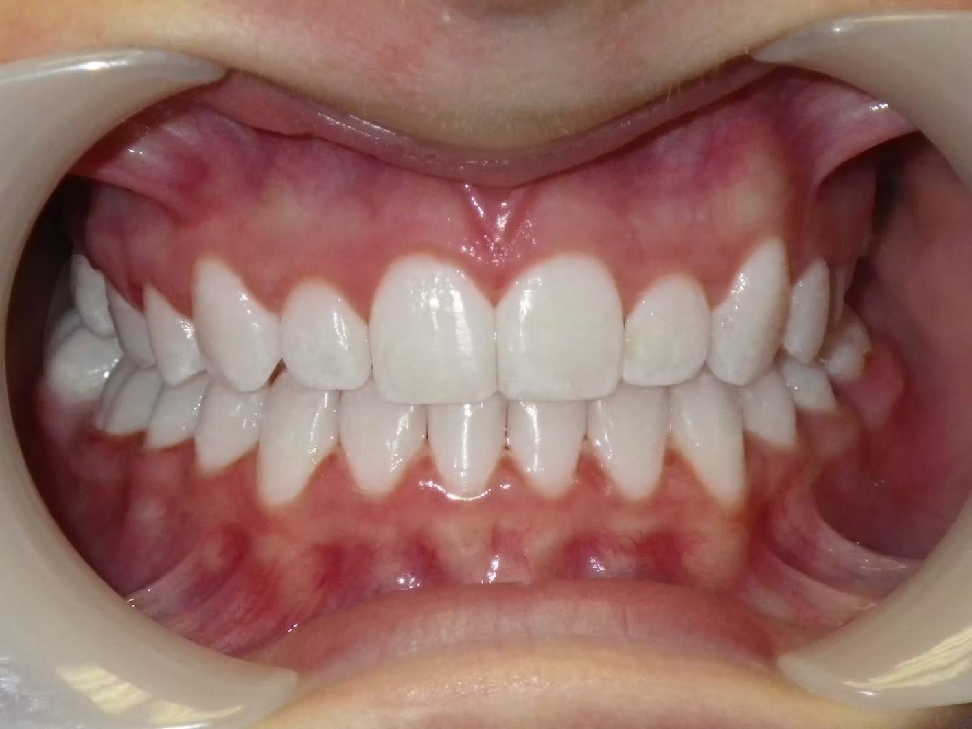 Close-up of a person's teeth, showing straight, white teeth in a healthy pink mouth, held open with a dental retractor.