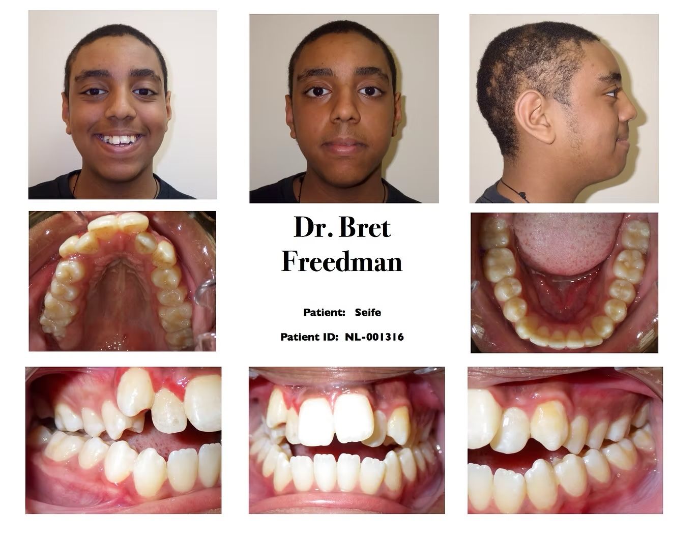 Orthodontic images: a person with dental issues before treatment. Views include face, mouth, and profile.