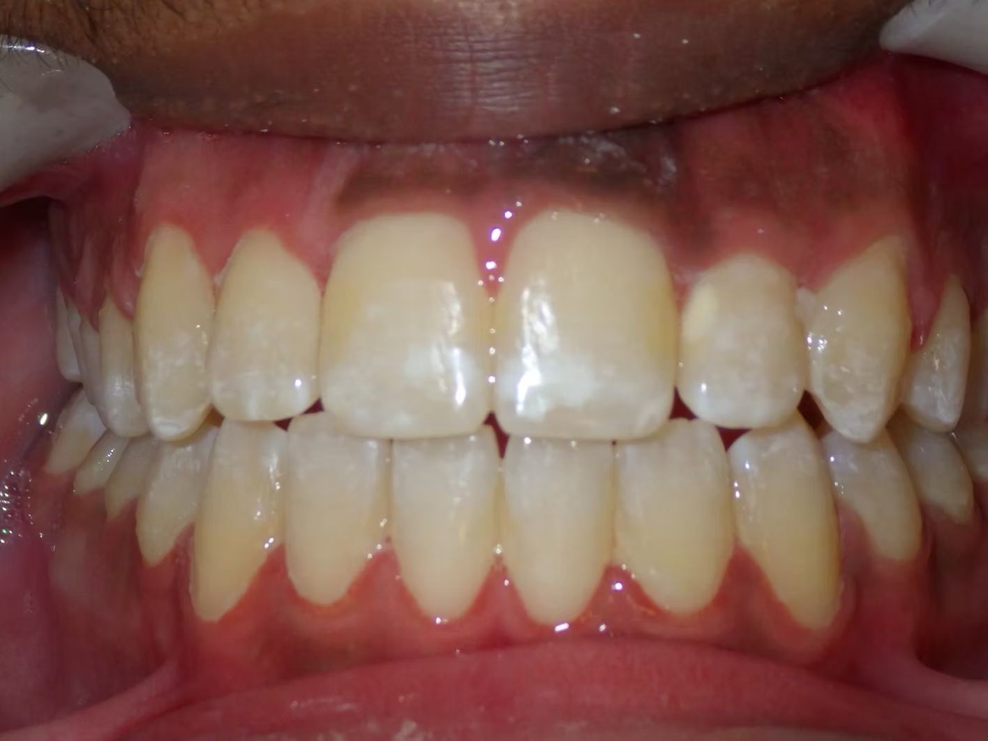 Close-up of teeth with white spots and a dark spot on the upper gumline.