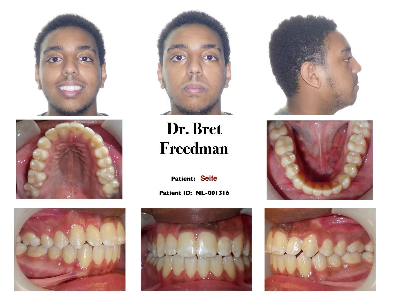 Orthodontic patient presentation, showing face, profile, and dental views.