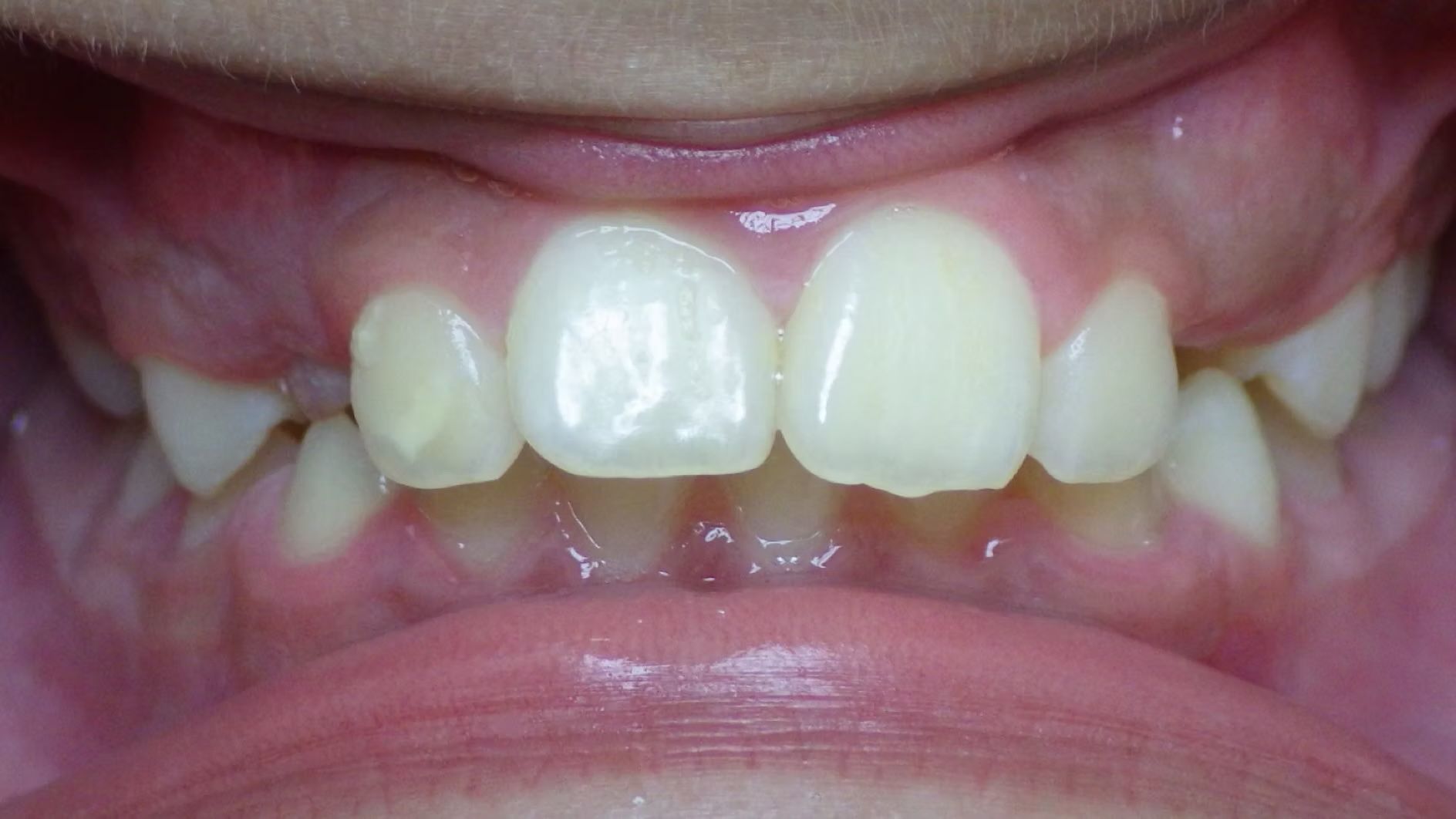 Close-up of a person's teeth, showing front teeth and surrounding gums; teeth appear slightly yellowed.