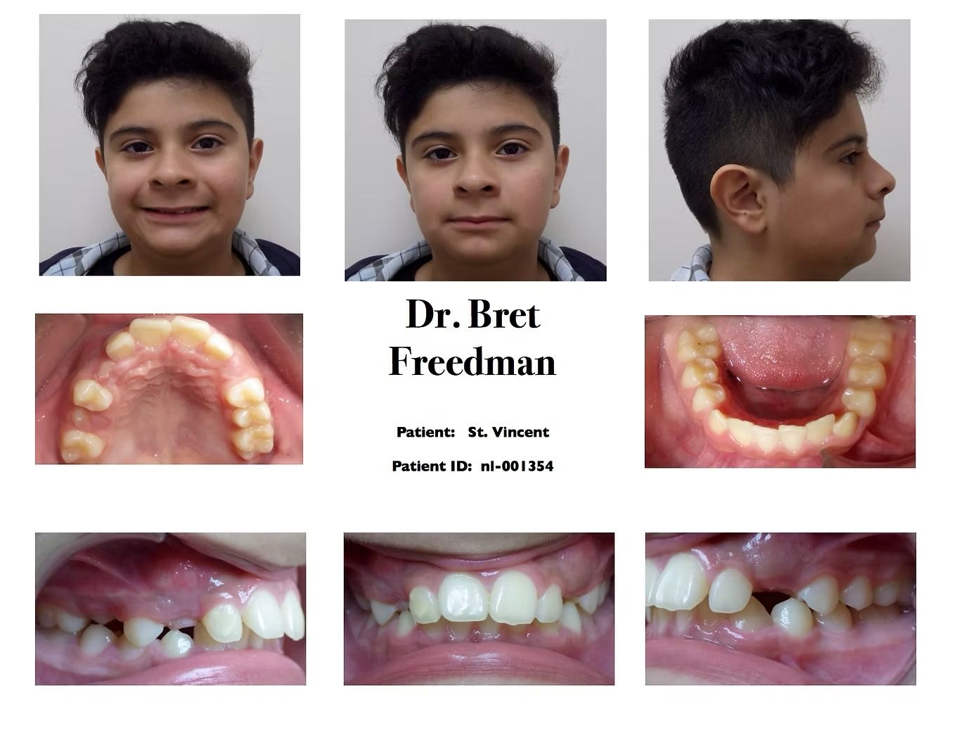 Dental examination photographs; frontal, profile, and intraoral views. Showing teeth, including a missing tooth.