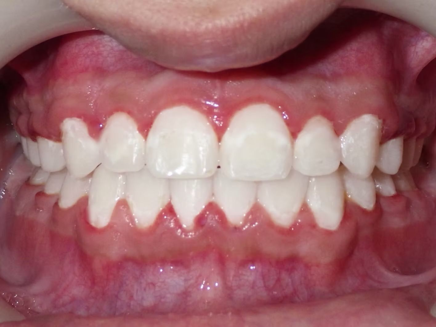 Close-up of teeth, displaying a white, symmetrical smile; pink gums are visible.