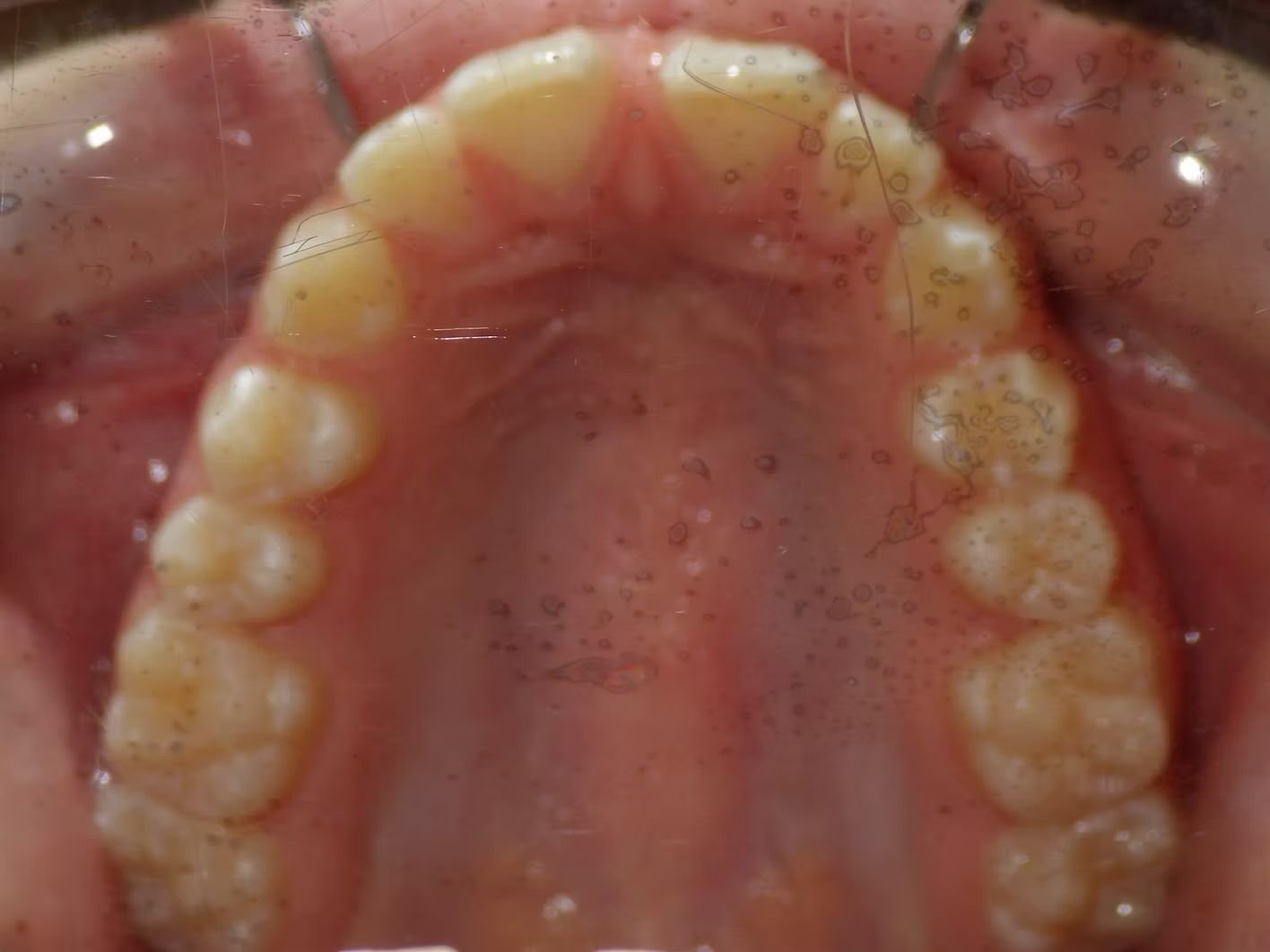 Upper view of a person's teeth. Yellowish teeth with light discoloration on the surface and pink gum.