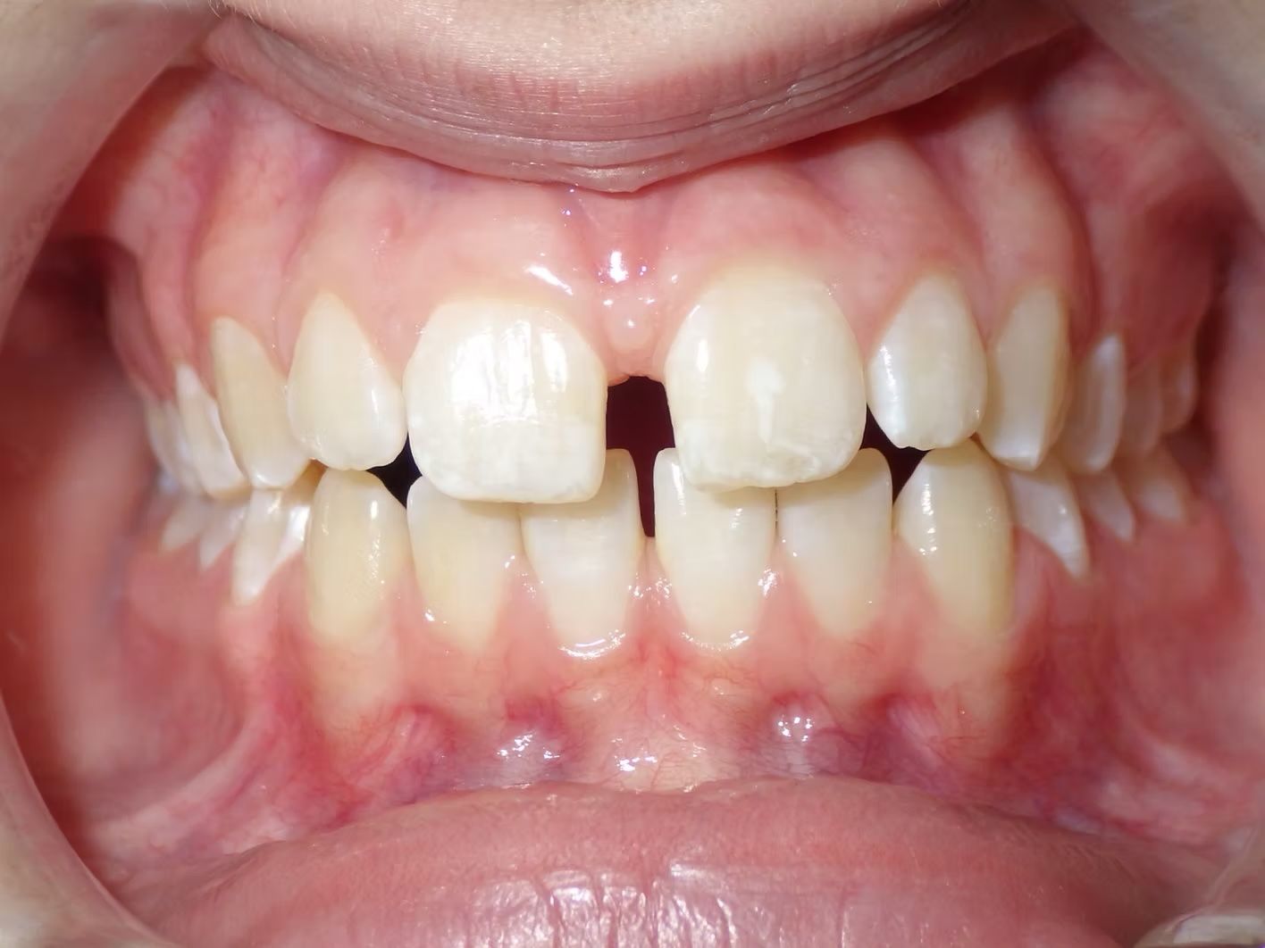 Mouth with prominent gap between two front teeth; slight chipping visible; light skin tone; pink gums.