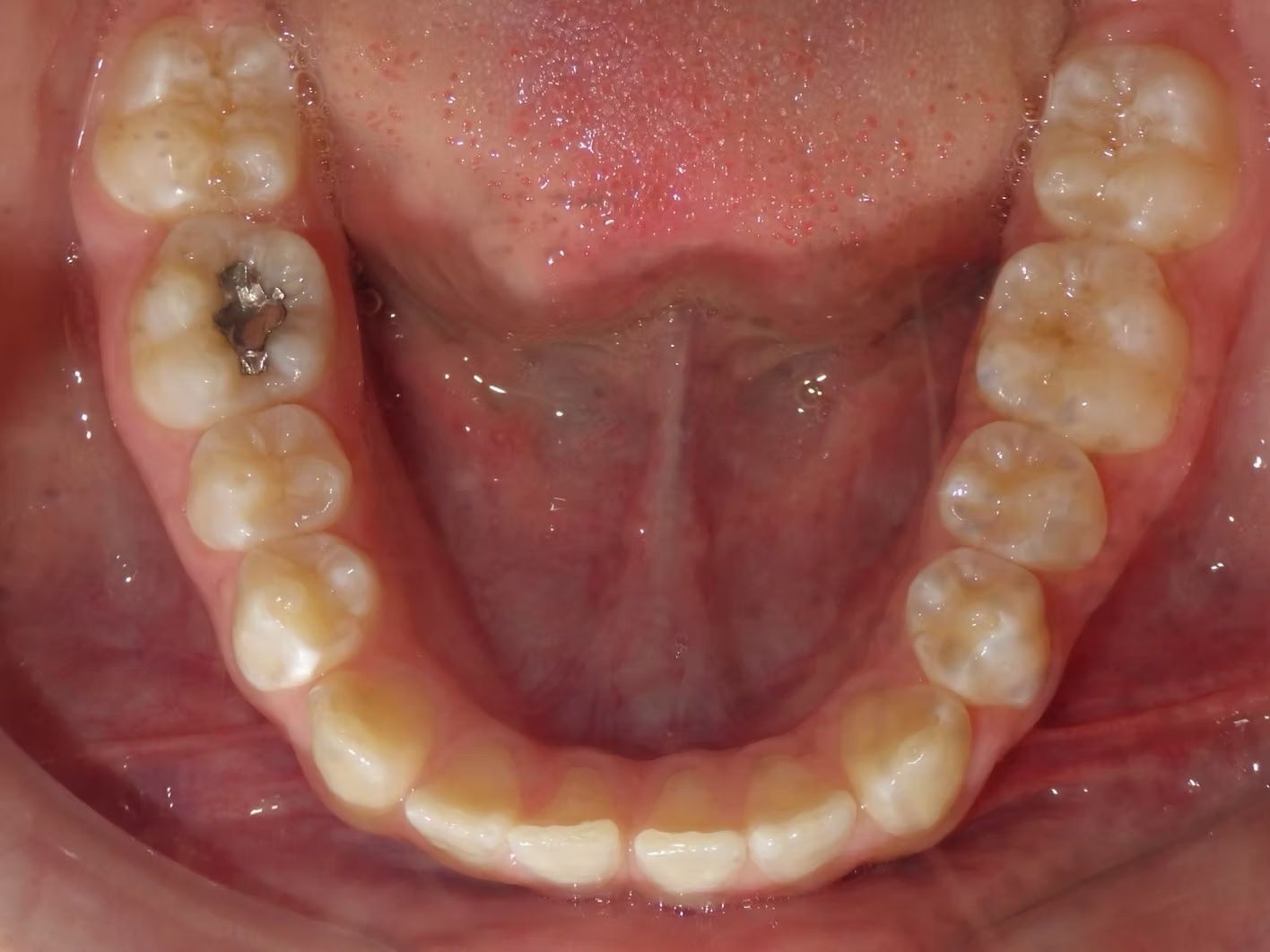 Upper teeth with one dark cavity, viewed from above.