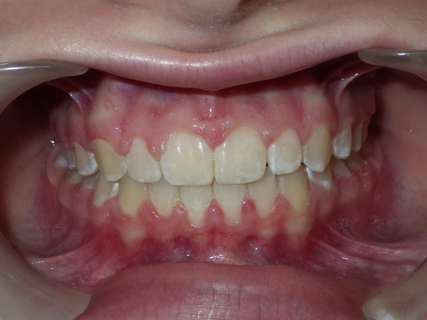 Close-up view of a person's teeth, showing alignment and slight discoloration.