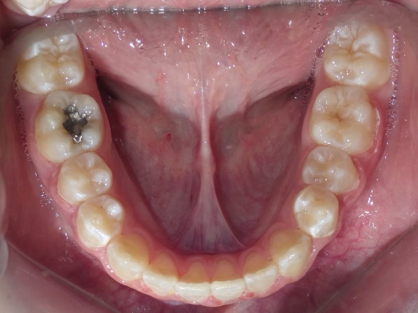 Interior view of a mouth showing lower teeth, tongue, and a filling.