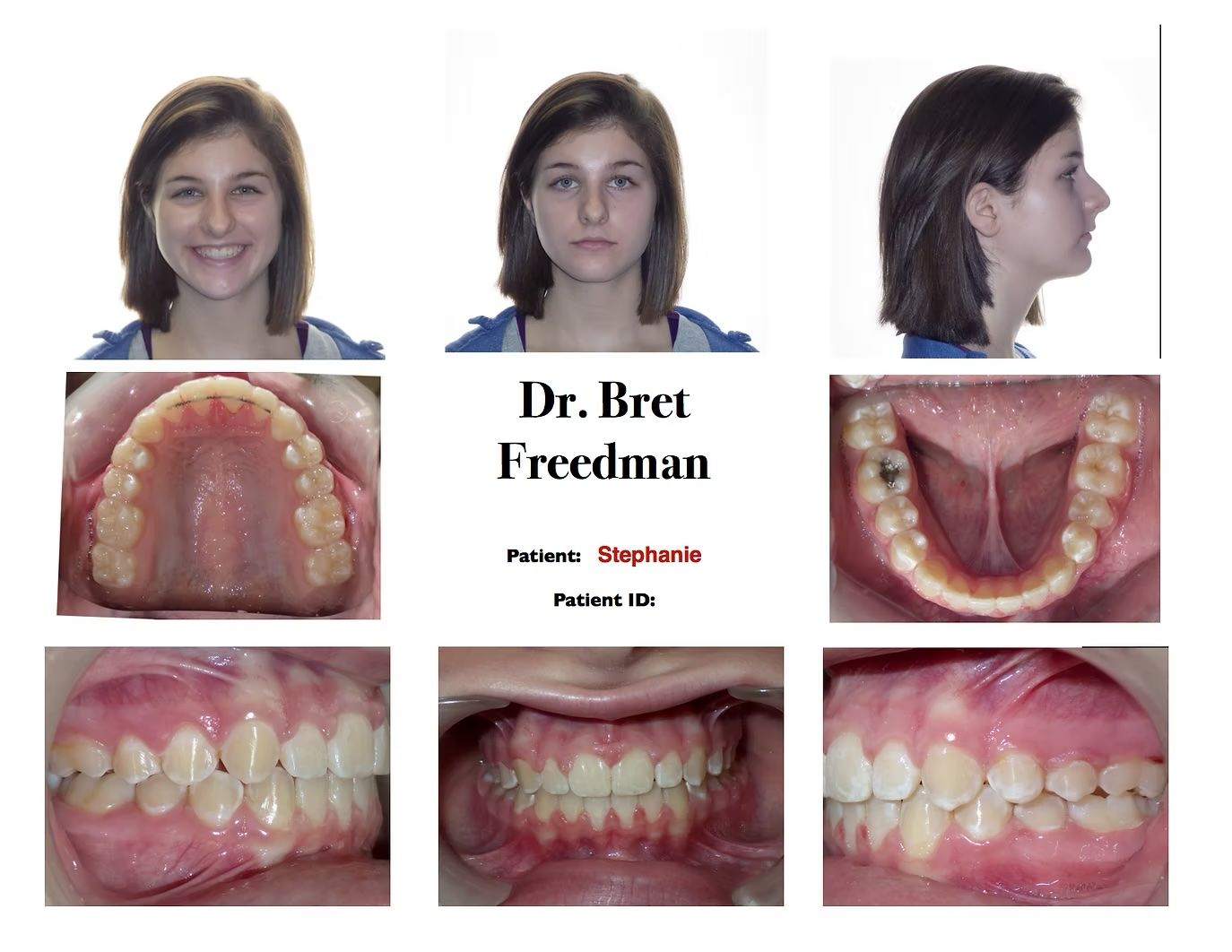 Orthodontic patient's dental and facial images. Includes front, side, and mouth views to document alignment.
