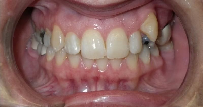 Mouth with exposed teeth; one upper tooth is partially missing and held by a dental appliance.