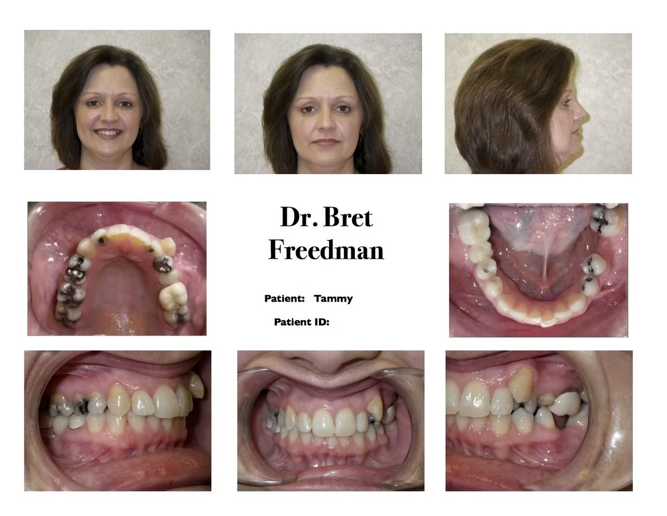 Woman's dental before and after photos. Shows full face and profile, plus close-ups of upper and lower teeth.