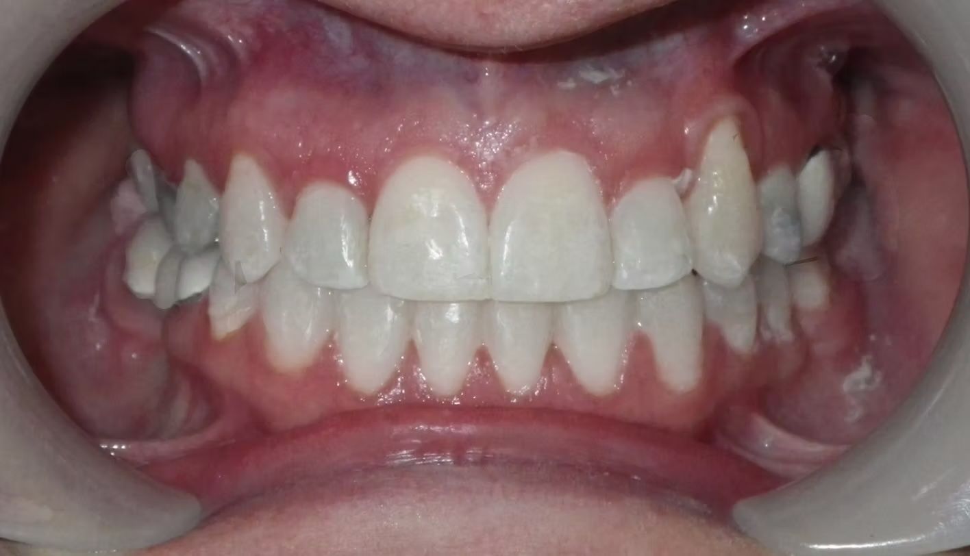 Close-up view of teeth showing straight, white teeth and pink gums, with a mouth retractor in use.