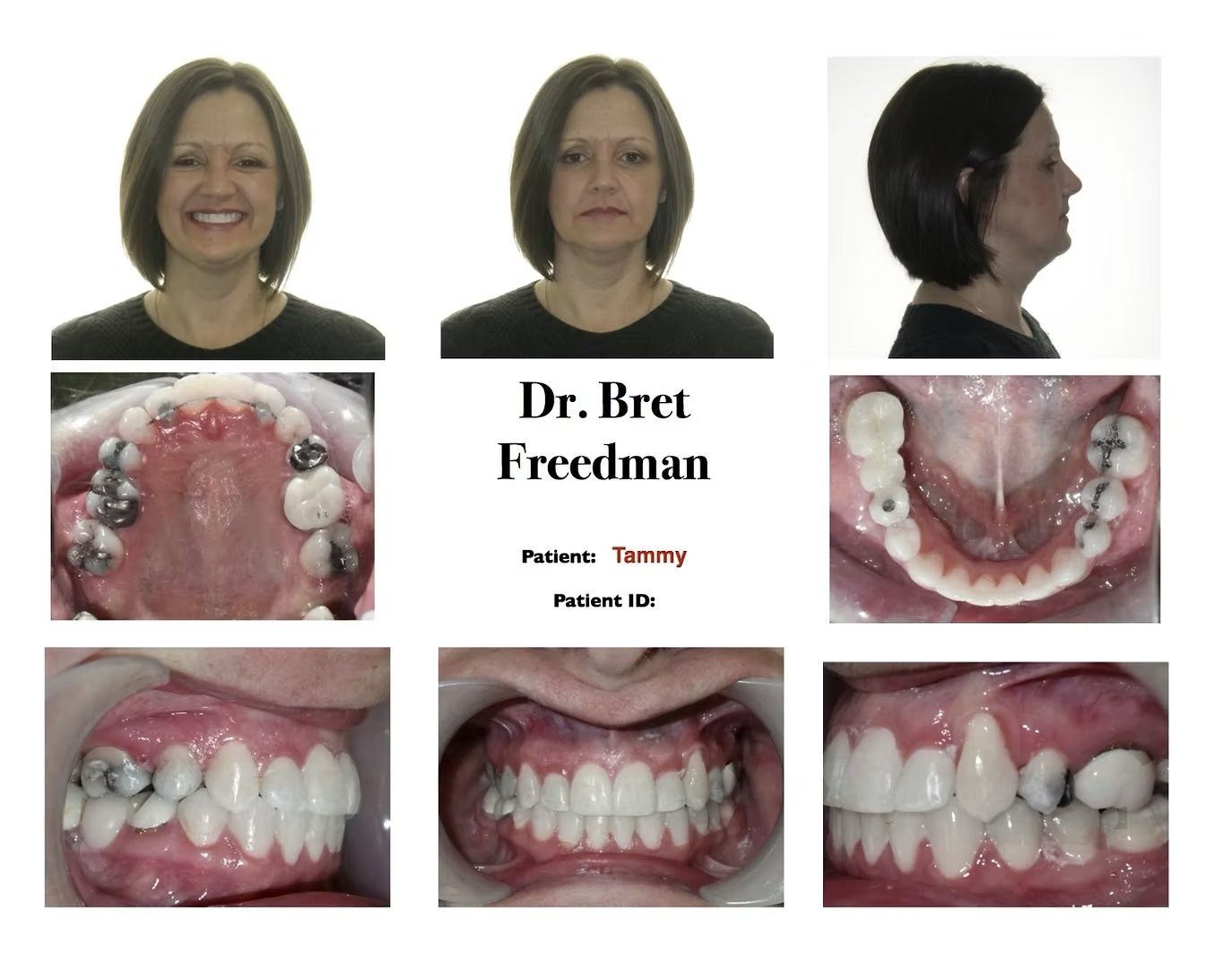 Orthodontics before-and-after photos: patient with teeth, smiling and neutral faces, side profile, and dental views.