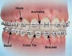 Teeth with silver braces. Arrows point to hook, archwire, color tie, band, and bracket.