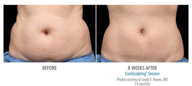 The Wall Center for Plastic Surgery & Jade MediSpa - Imagine losing over 2  inches in your waist without surgery! This patient had 2 CoolSculpting  treatments to his love handles. Before his