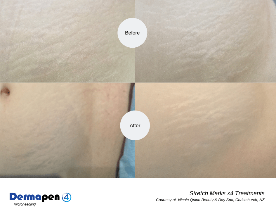 The Power of Micro-Needling as Stretch Marks Removal Treatment