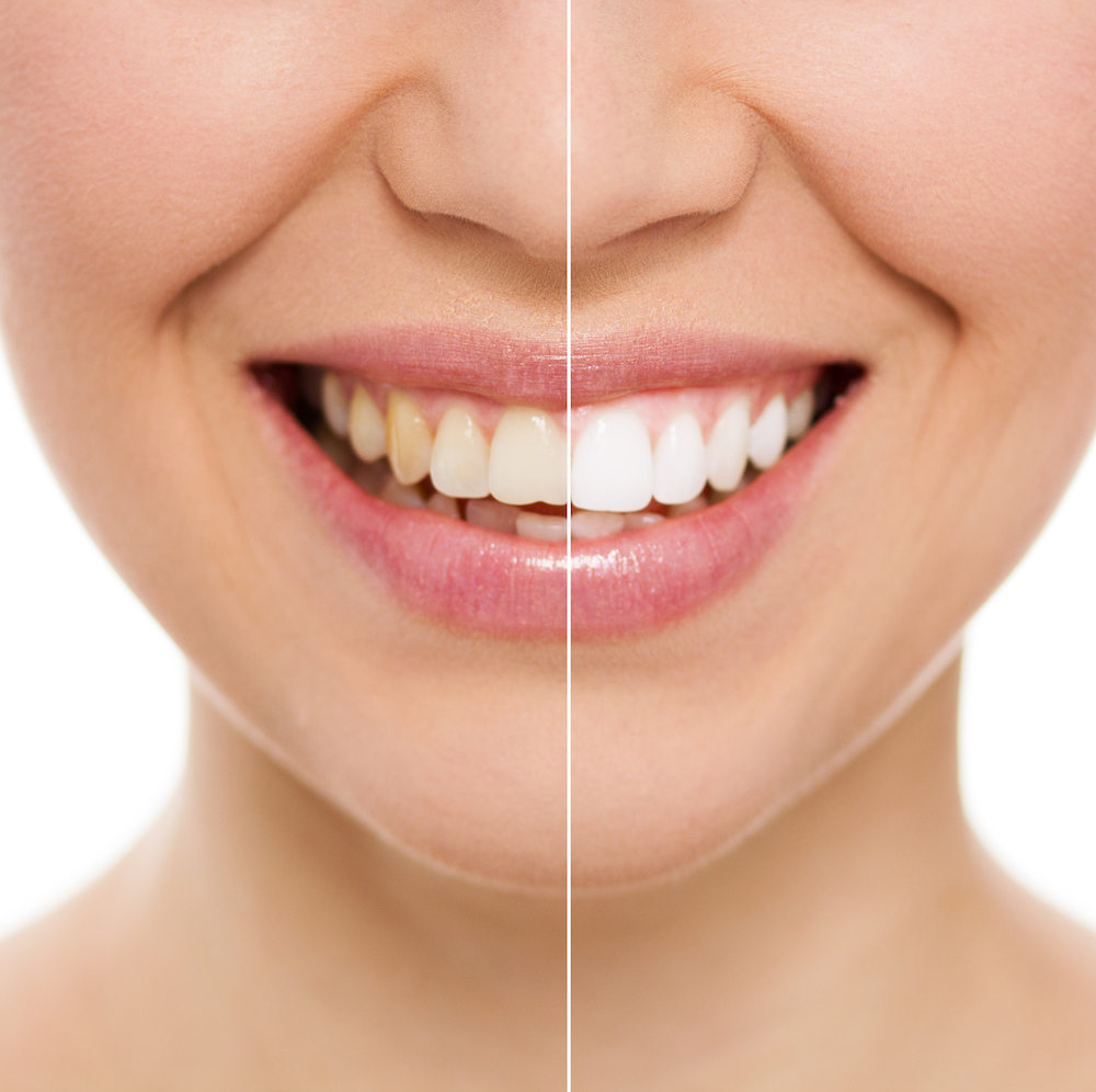 Smiling woman's teeth before and after whitening, showing a noticeable color difference.