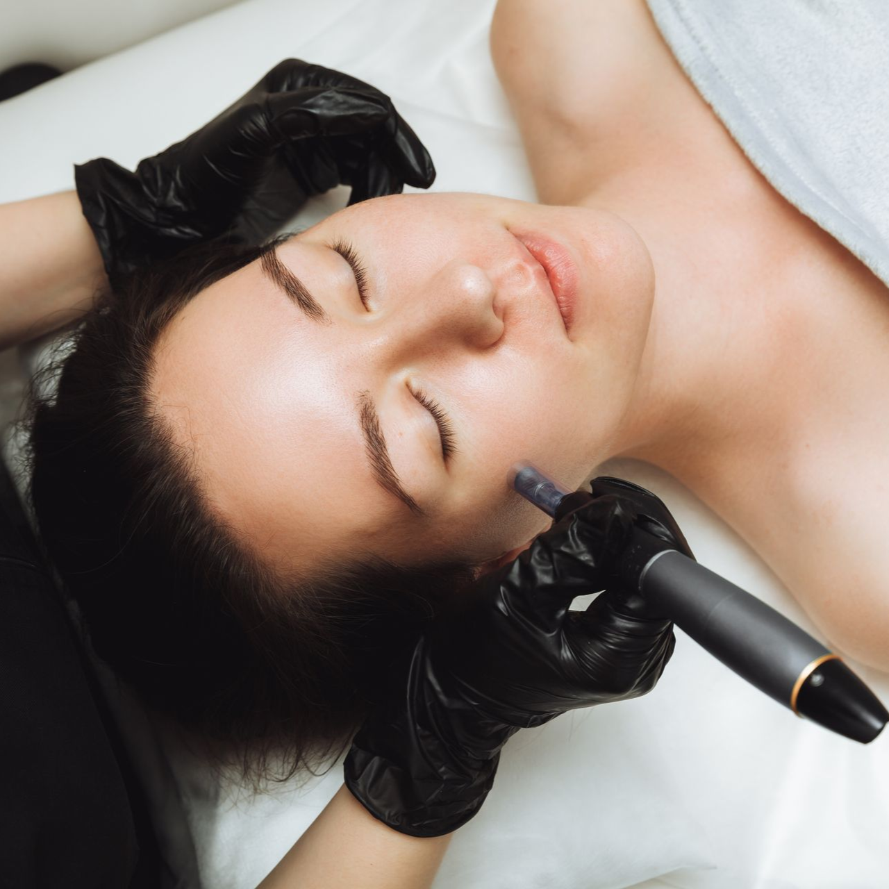 microneedling