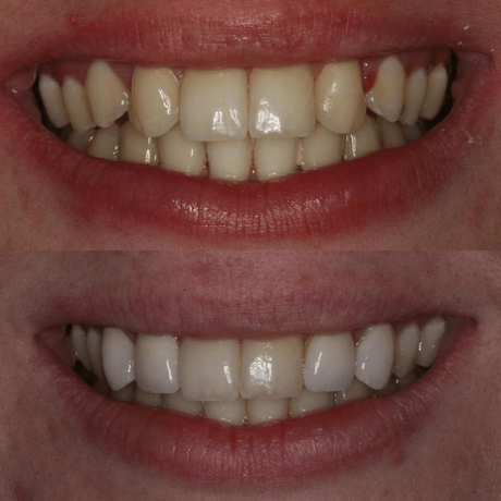 Veneers smile makeover