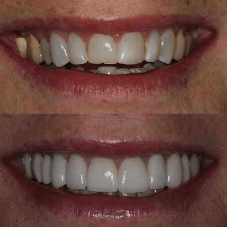 full mouth smile makeover