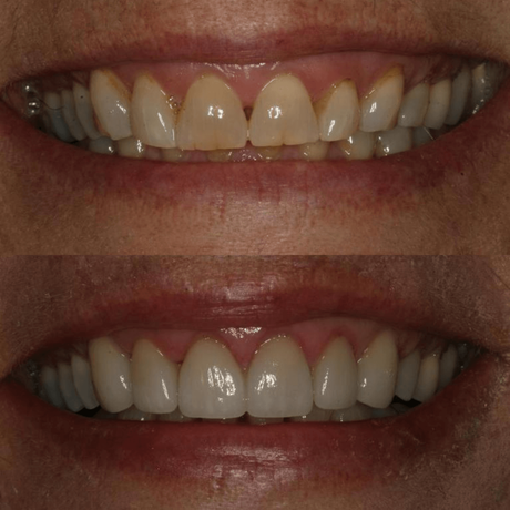 correcting smile makeover